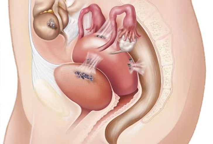 Endometriosis Symptoms Endometriosis Symptoms