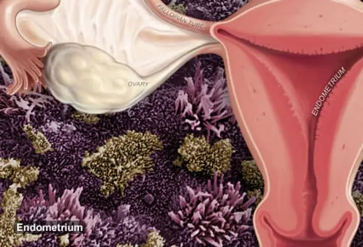 What is Endometriosis? What is Endometriosis?