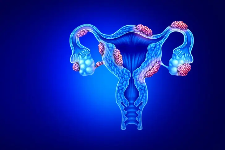 Endometriosis and Fallopian Tube Problems
