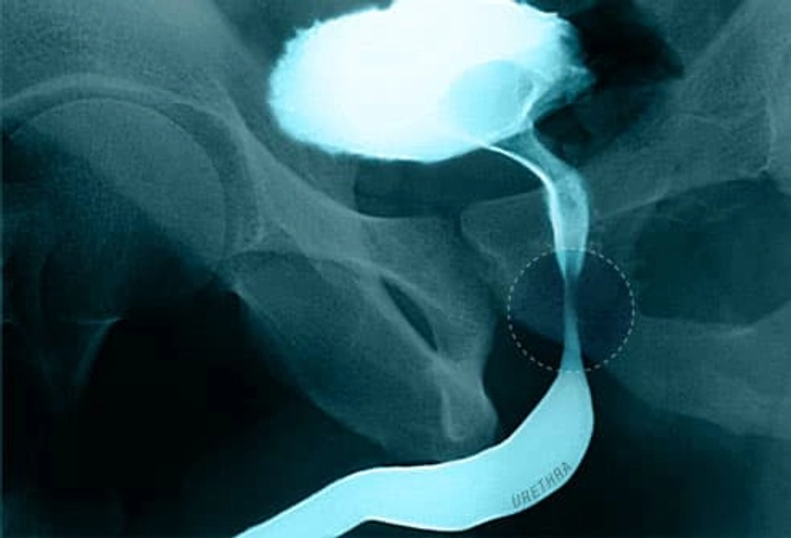 Symptom: Inability to Urinate
