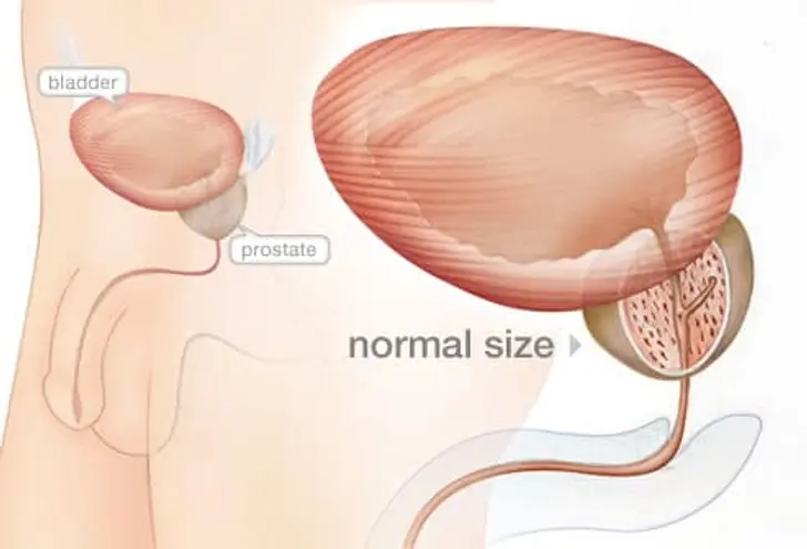 What is an Enlarged Prostate?