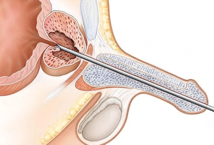 Treatment: Less Invasive Procedures