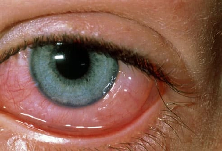 Why Are My Eyes Red?