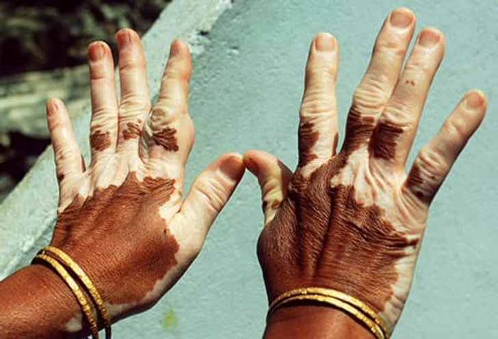 Vitiligo Vitiligo