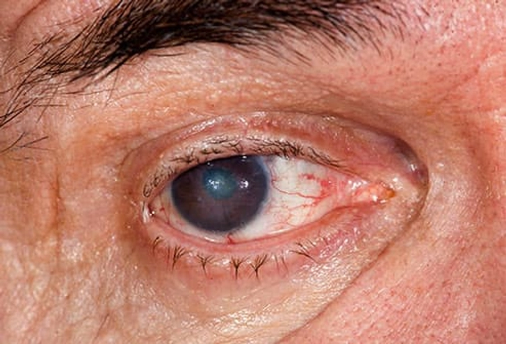 Cataracts Cataracts