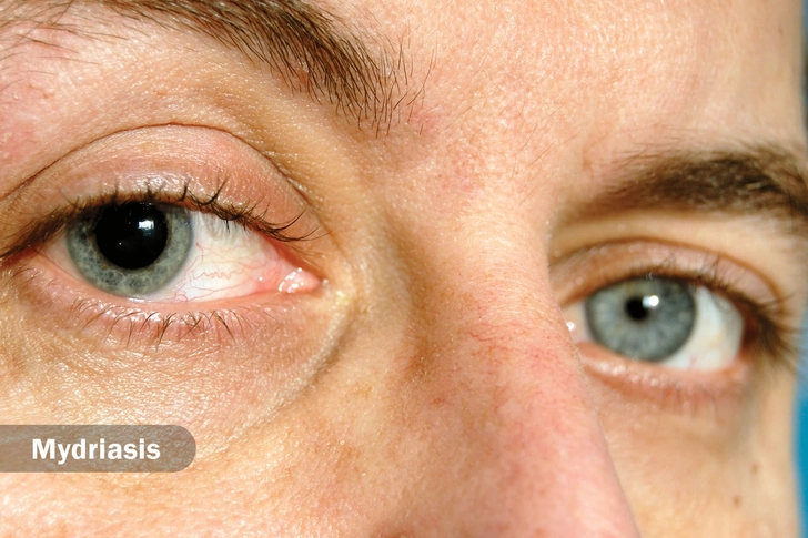 Odd-Sized Pupils
