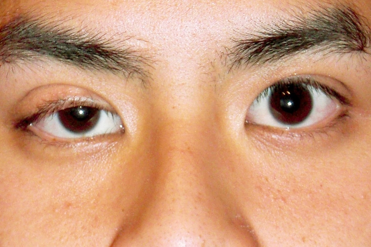 Droopy Eyelids