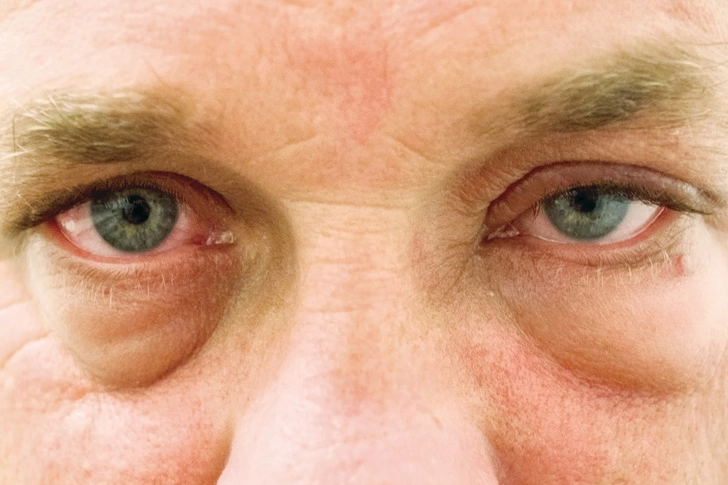 Puffy Eyes