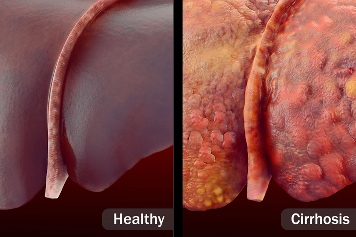 Metabolic Dysfunction-Associated Steatotic Liver Disease (ΜΑЅLD)