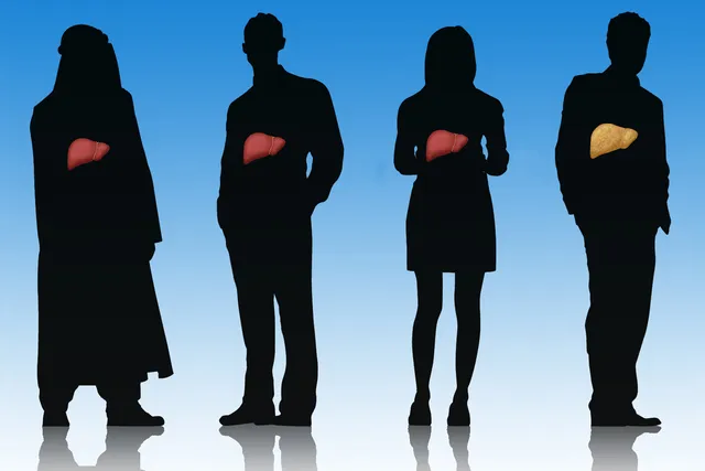 A Visual Guide to Fatty Liver