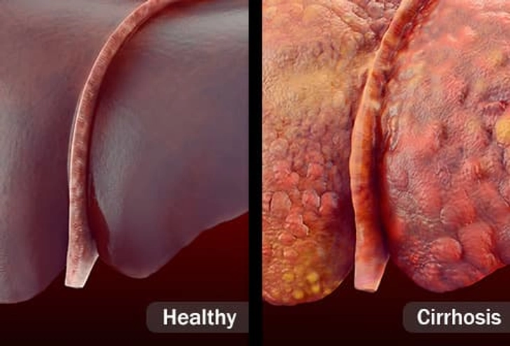 Nonalcoholic Fatty Liver Disease Nonalcoholic Fatty Liver Disease