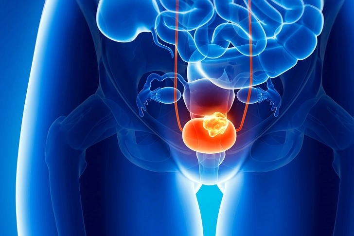 Lowering Bladder Cancer Risk Lowering Bladder Cancer Risk