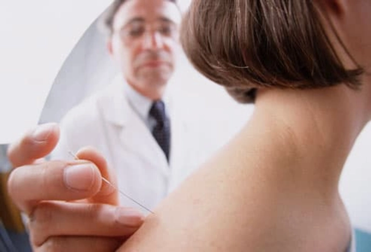 Acupuncture Acupuncture