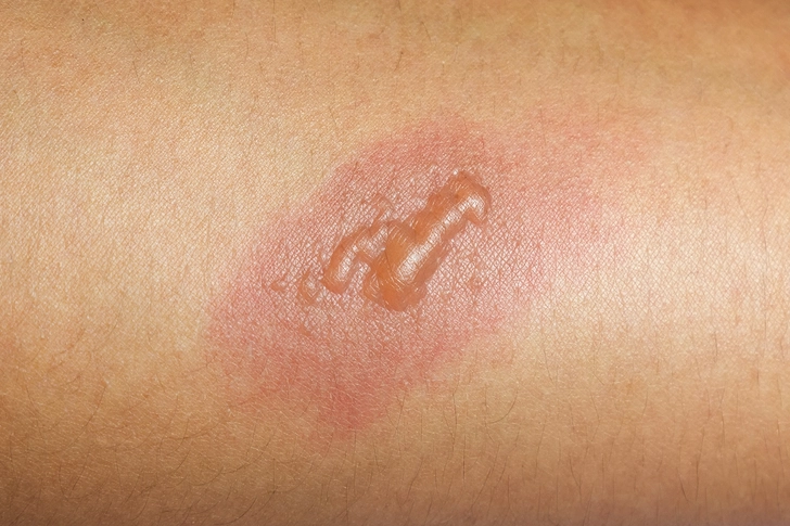 Don’t: Butter Your Burns Don’t: Butter Your Burns