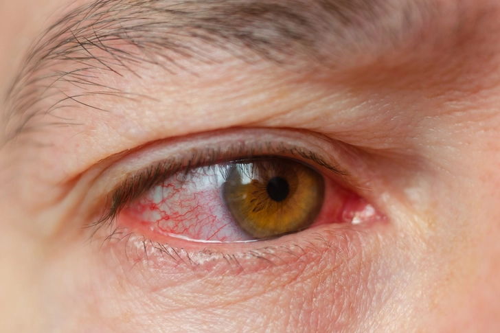 Don’t: Rub an Injured Eye Don’t: Rub an Injured Eye