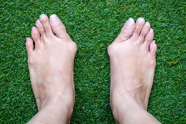 Bunions