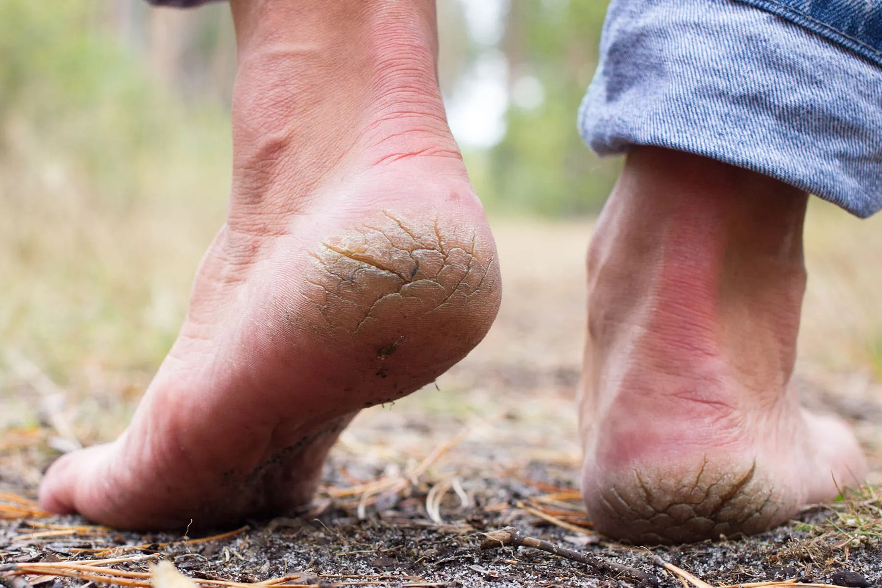photo of cracked heels