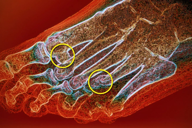 Osteoarthritis