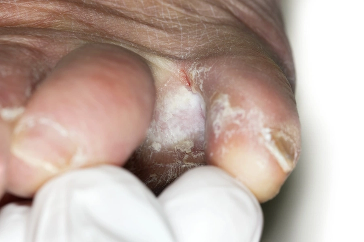 Fungal Infections Fungal Infections