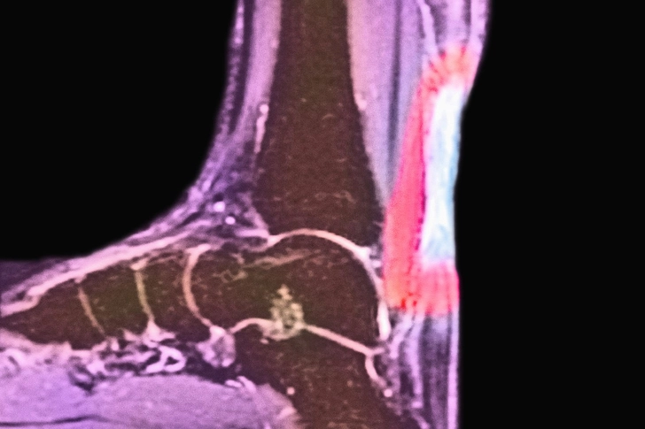 Achilles Tendinitis Achilles Tendinitis