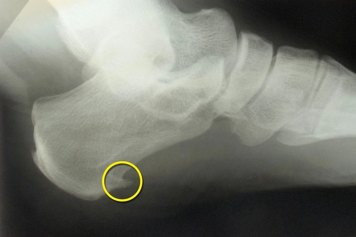 Bone Spurs Bone Spurs