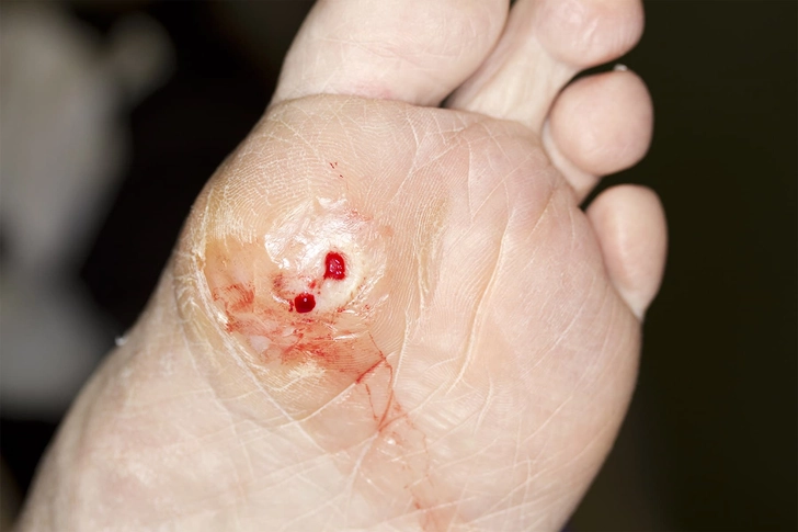 Diabetic Foot Ulcer Diabetic Foot Ulcer