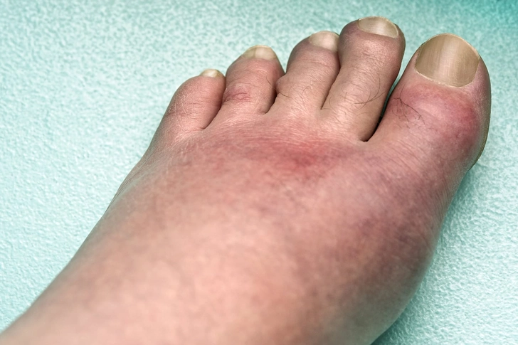 Gout Gout