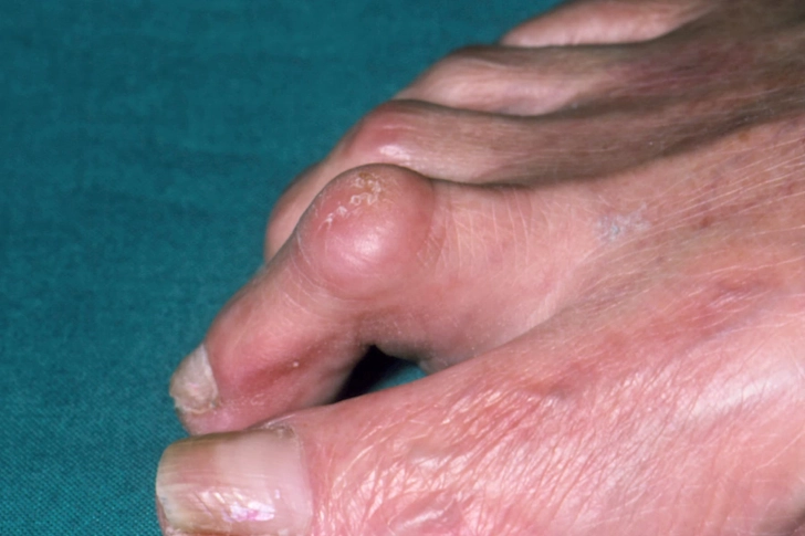 Hammertoe