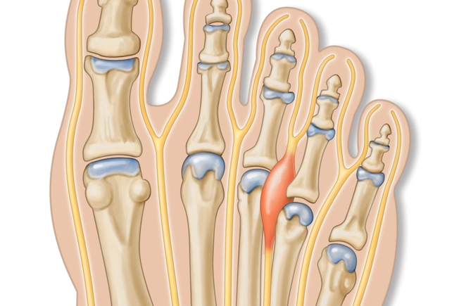 Morton’s Neuroma