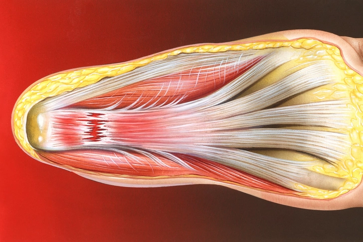 Plantar Fasciitis Plantar Fasciitis