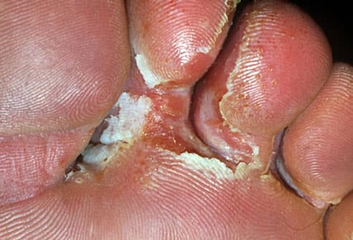 Athlete's Foot Athlete's Foot