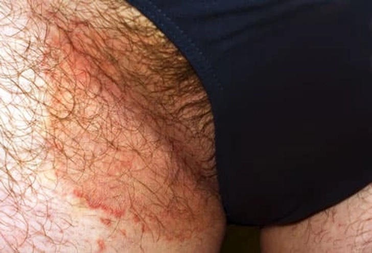 Jock Itch Jock Itch