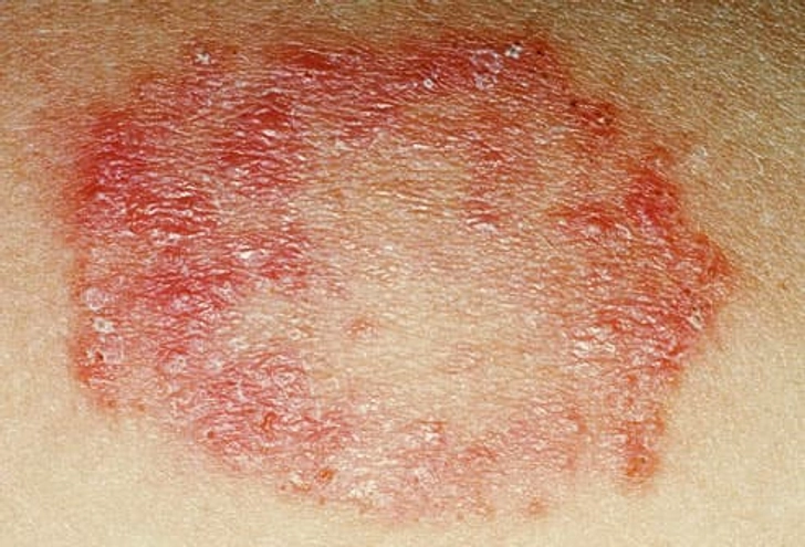 Ringworm Ringworm