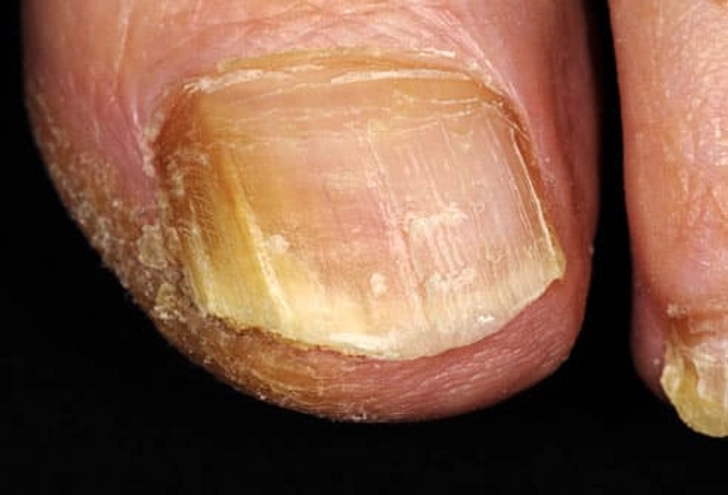 Nail Fungus Nail Fungus