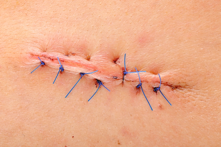 Open Gallbladder Surgery