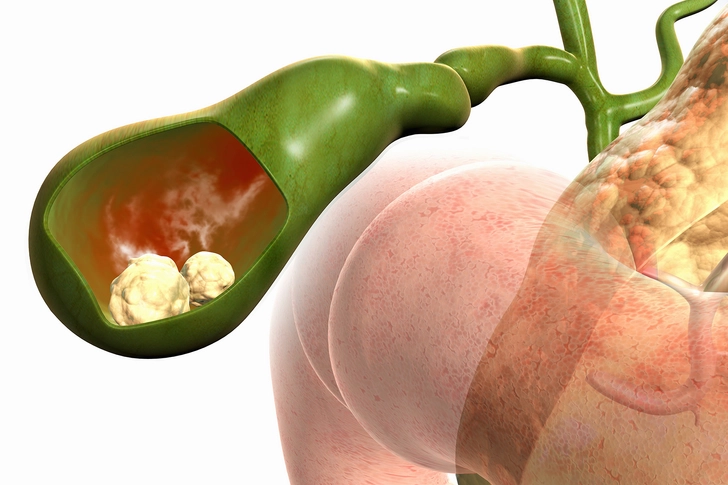 What Are Gallstones? What Are Gallstones?
