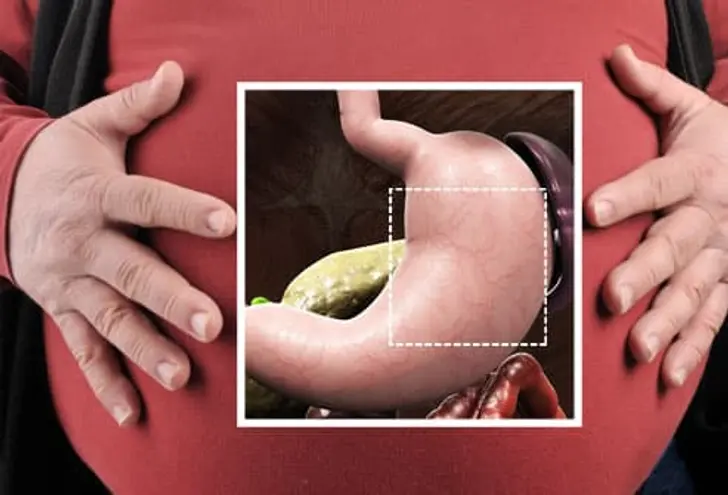How Does Weight Loss Surgery Work?