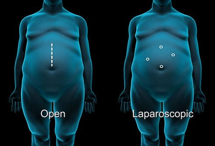 Surgical Methods