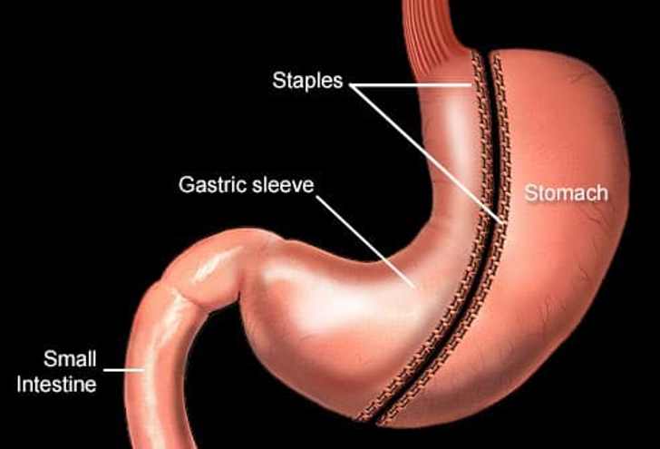 Gastric "Sleeve"
