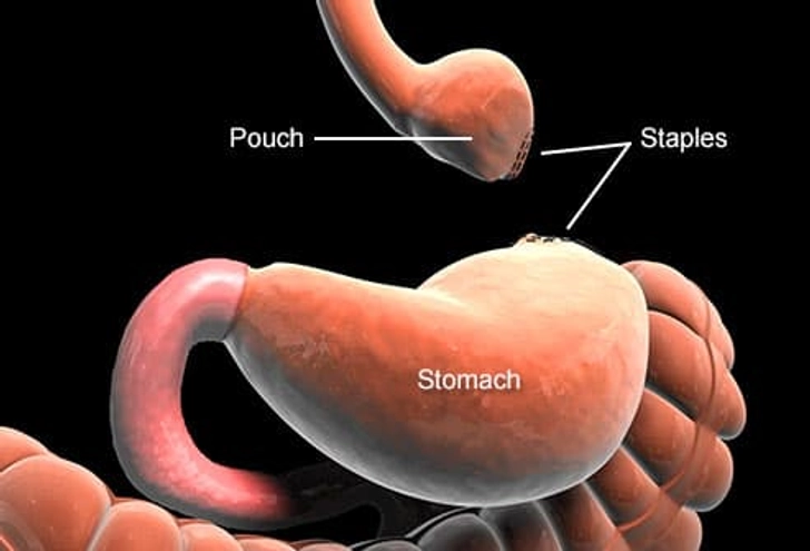 Roux-en-Y Gastric Bypass