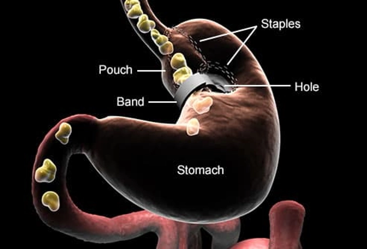 Biliopancreatic Diversion