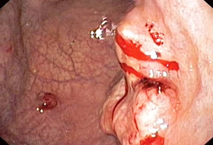 Adenocarcinoma