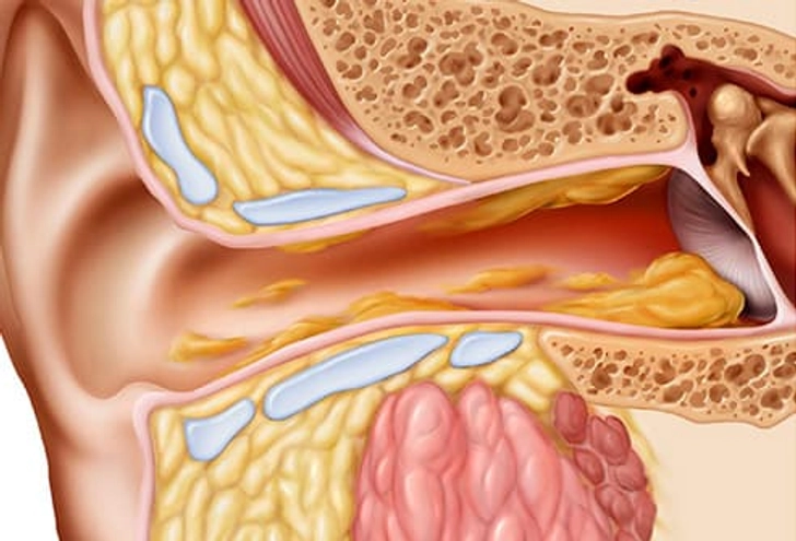 Earwax Earwax
