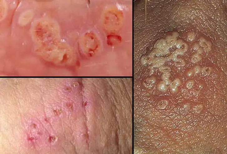 Genital Herpes Symptoms Genital Herpes Symptoms