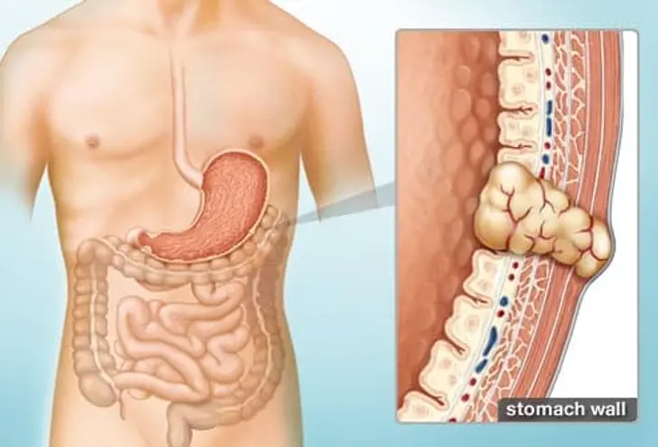 Treating Gastrointestinal Stromal Tumors Treating Gastrointestinal Stromal Tumors