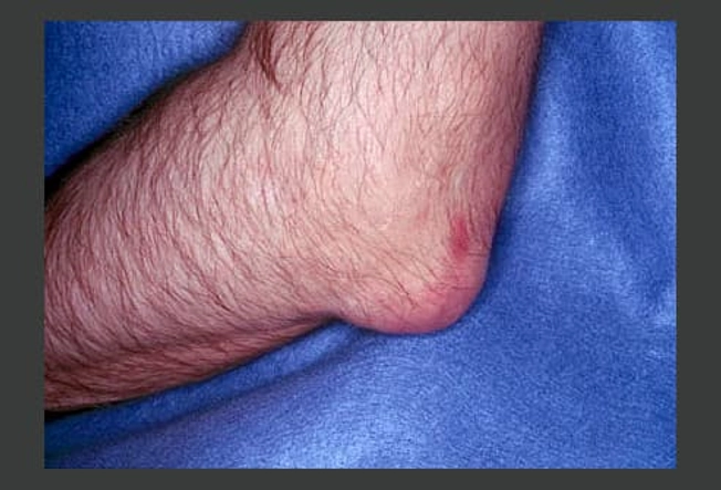 What Gout Looks Like: The Elbow
