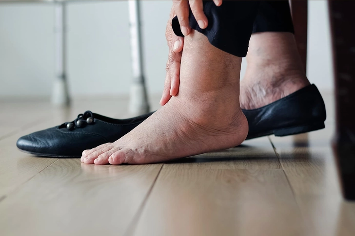 Inflammation Inflammation