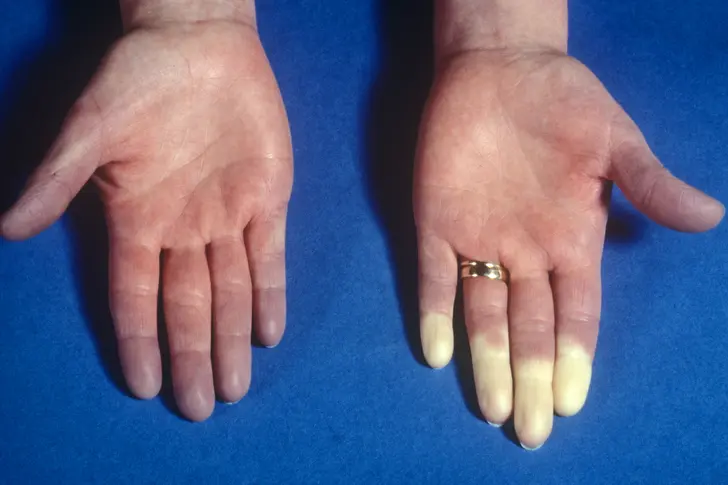 Raynaud’s Phenomenon Raynaud’s Phenomenon