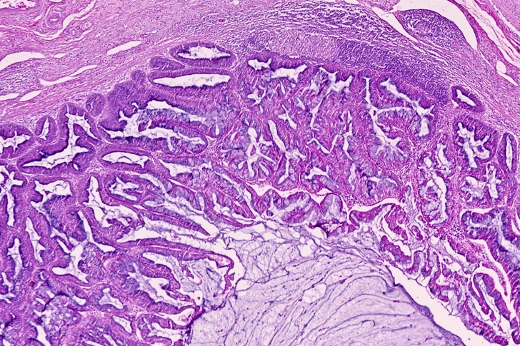 Type: Adenocarcinomas