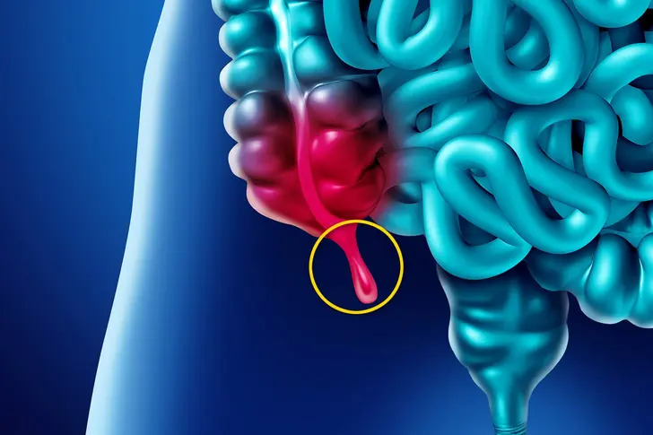 Your Appendix
